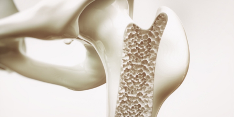 Osteoporosi: conoscerla e prevenirla